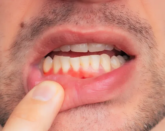 Antibiotic Periodontal Treatment at Smile Breeze Dentistry